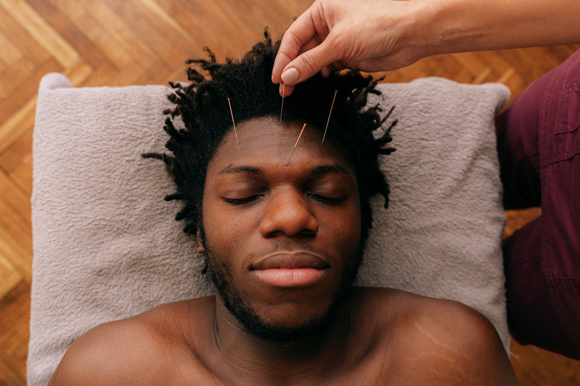 Acupuntura facial
