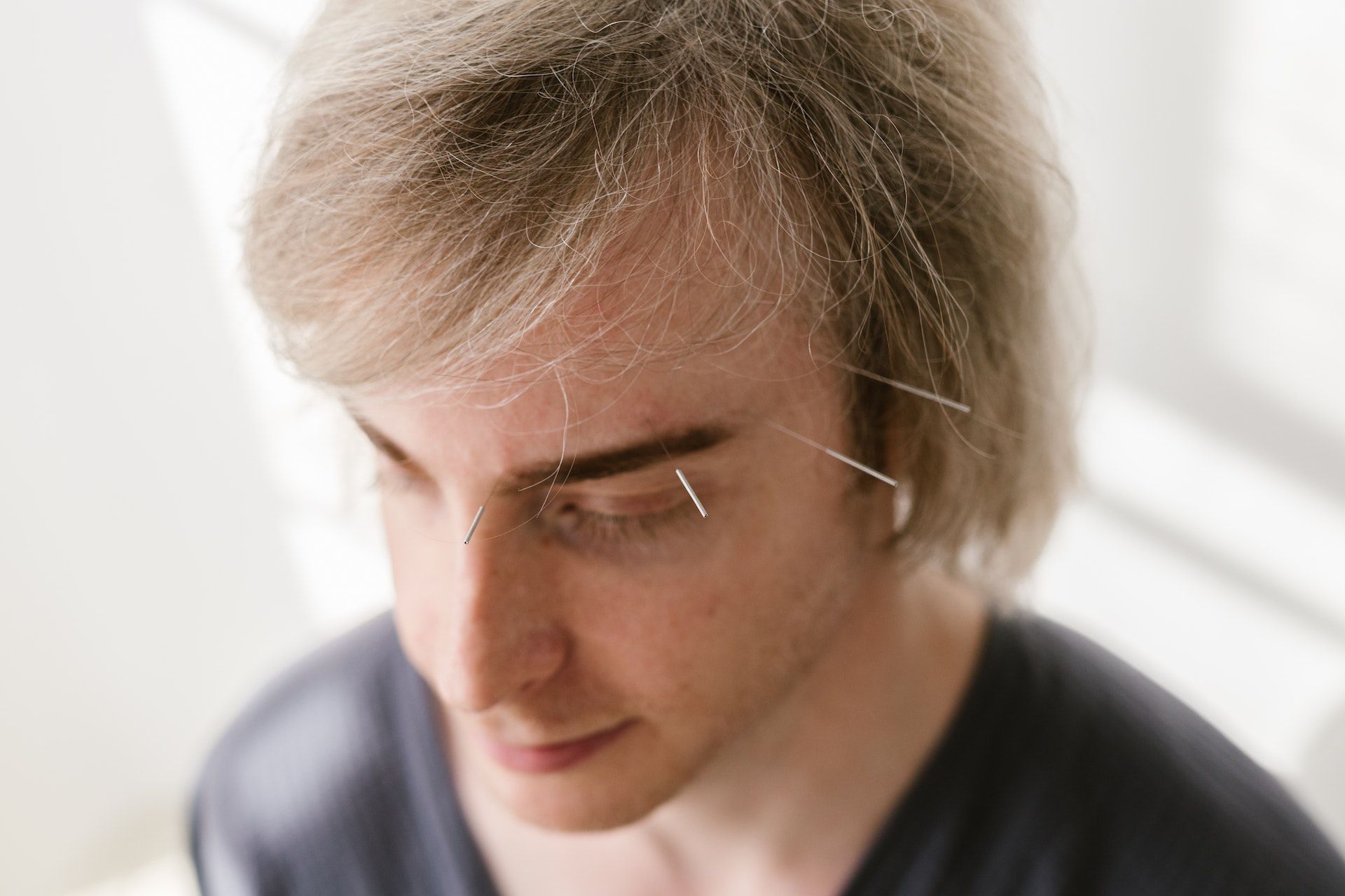 Acupuntura facial
